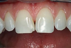 Ballard Dentistry | Implant Dentistry, Teeth Whitening and Preventative Program
